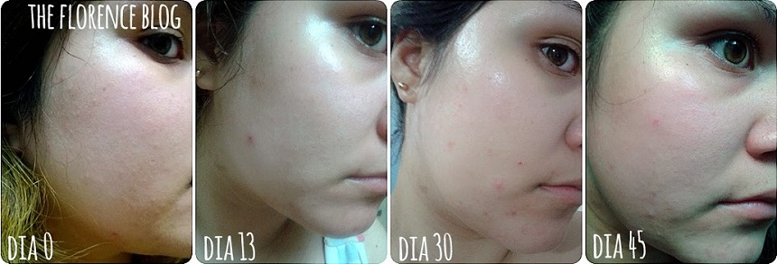 Kem trị mụn La Roche-Posay Effaclar Duo+