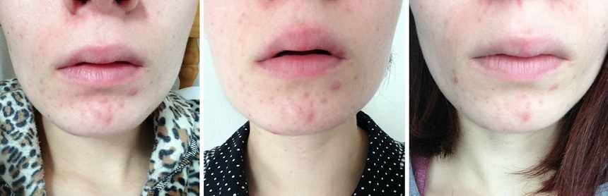 Kem trị mụn La Roche-Posay Effaclar Duo+