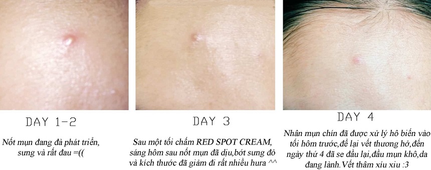 Kem trị mụn Ciracle Red Spot Cream